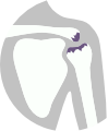 Léčba bolesti ramene - osteoartróza